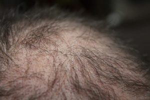 tips for hair regrowth