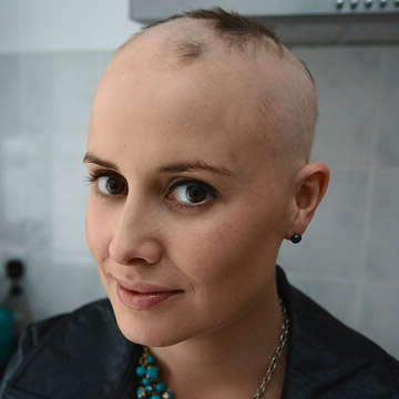 alopecia complete hair loss