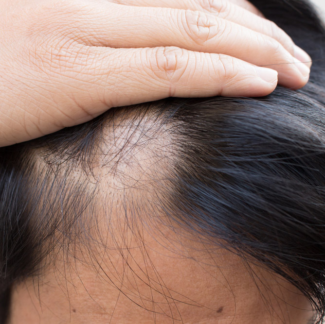 treatment for alopecia brisbane