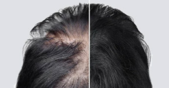 alopecia treatment plan brisbane