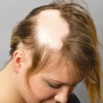 treat female hair loss brisbane, How To Treat Female Hair Loss In Brisbane