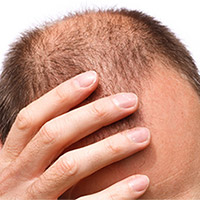 Hair Loss Treatment Brisbane, Hair Loss