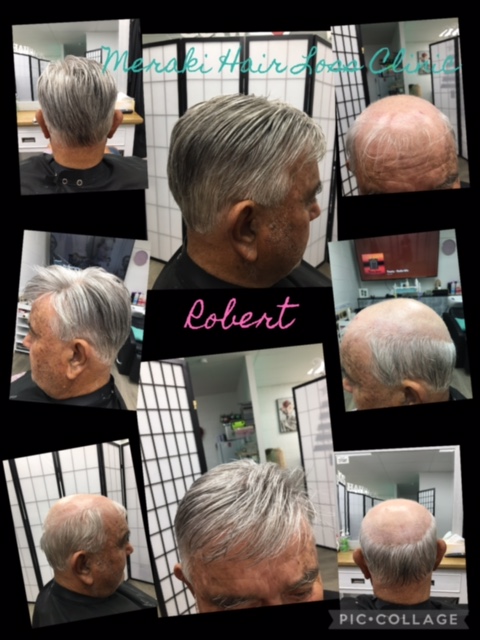 Recent Hair Loss Treatment Results
