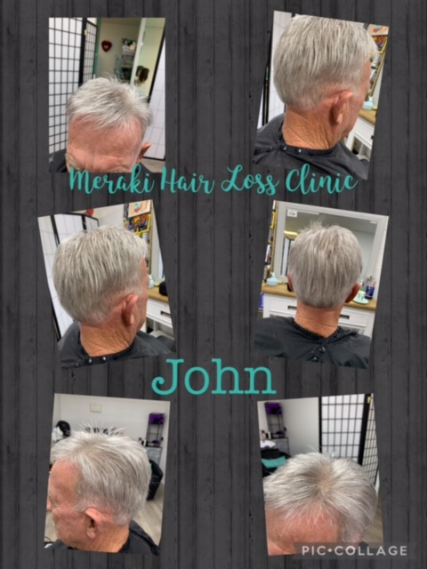 Hair Loss Treatment Results, Results