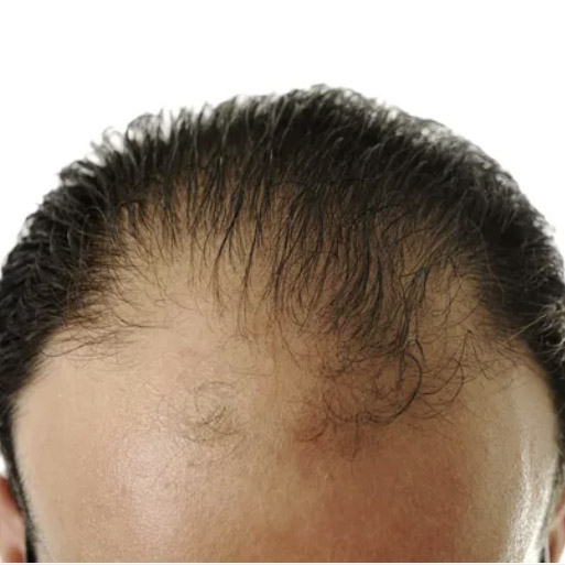 How should you explain to people that you have a hair loss condition