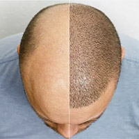male hair loss treatments