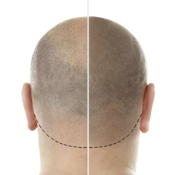 scalp micropigmentation Brisbane, Scalp Micro Pigmentation Treatment