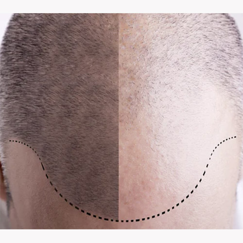 treatment for alopecia brisbane