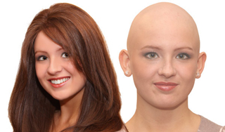 alopecia hairloss solutions brisbane