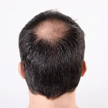 Men’s Hair Loss, Men’s Hair Loss