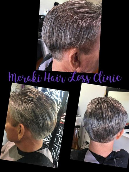 tango hair loss clinic brisbane, Tango Hair Loss Clinic Is Now Meraki Hair Loss Clinic Brisbane
